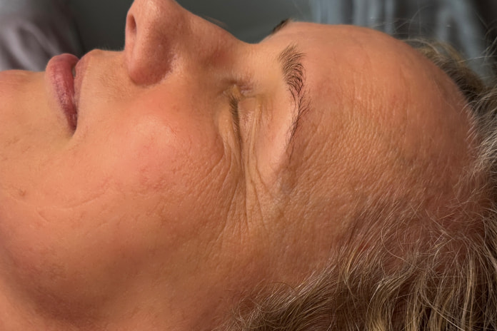 Skin result after treatments at SkinCareWithMargo