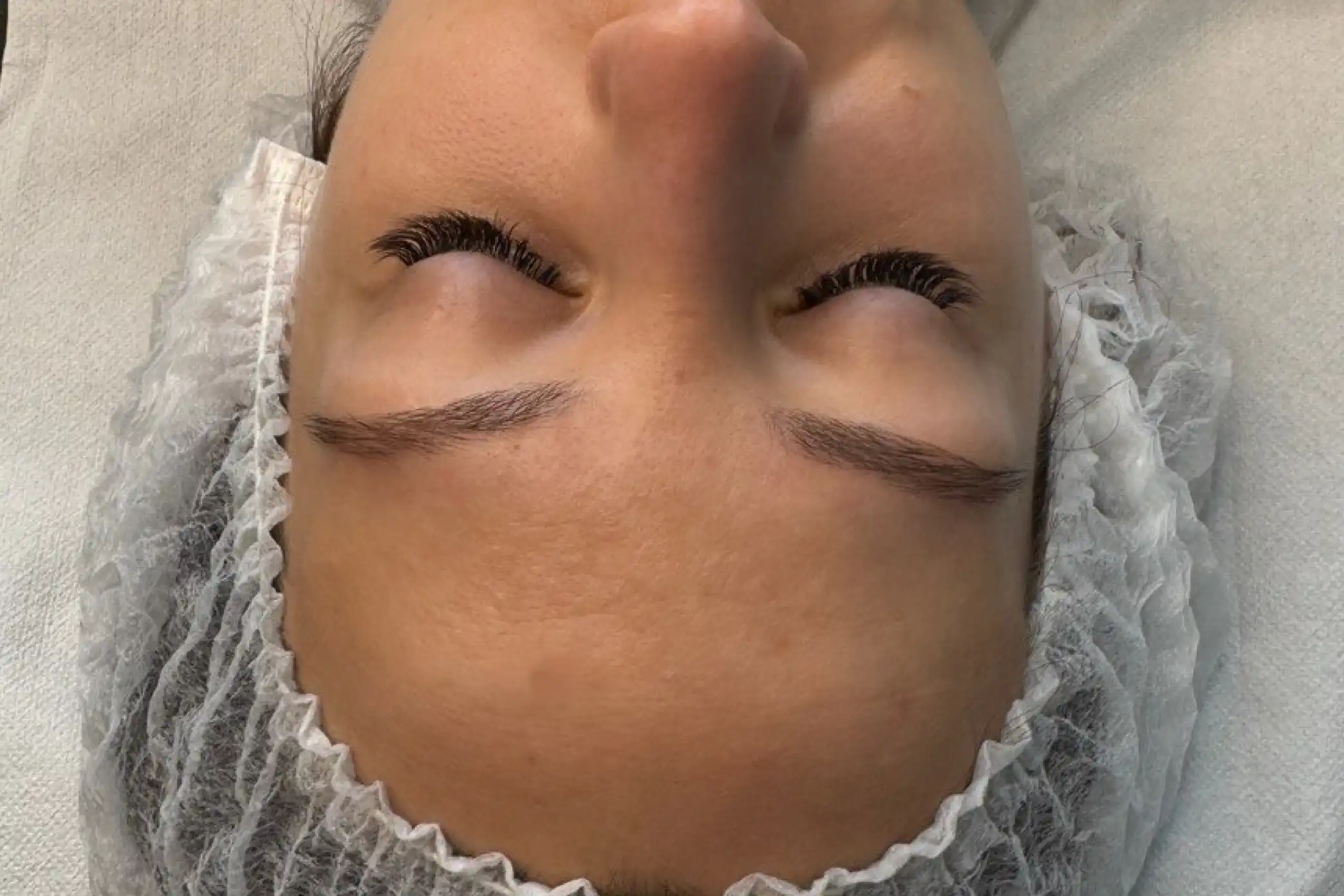 Result after a series of microneedling treatments at SkinCareWithMargo in Krakow