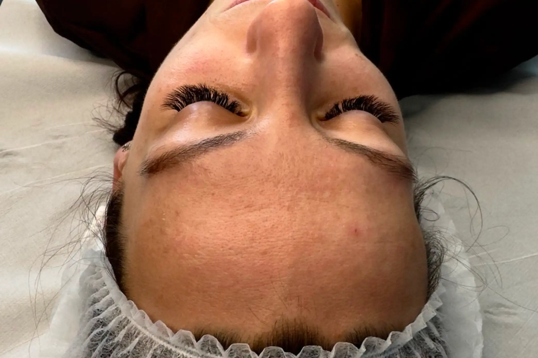Skin before a series of microneedling treatments at SkinCareWithMargo in Krakow